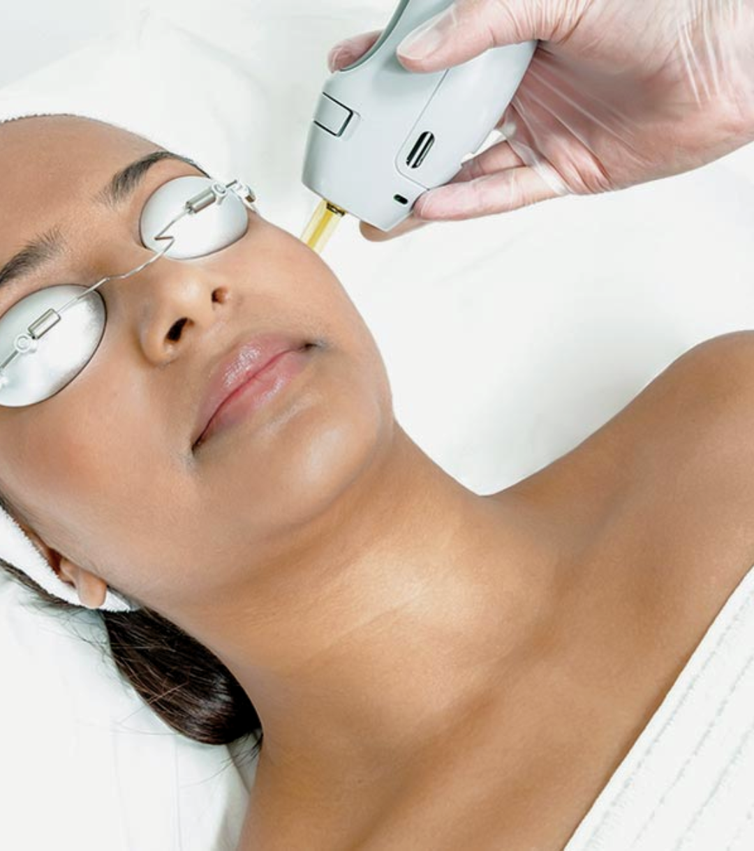 Laser skin resurfacing using Candela GentleMax Pro at VIVE Med Center