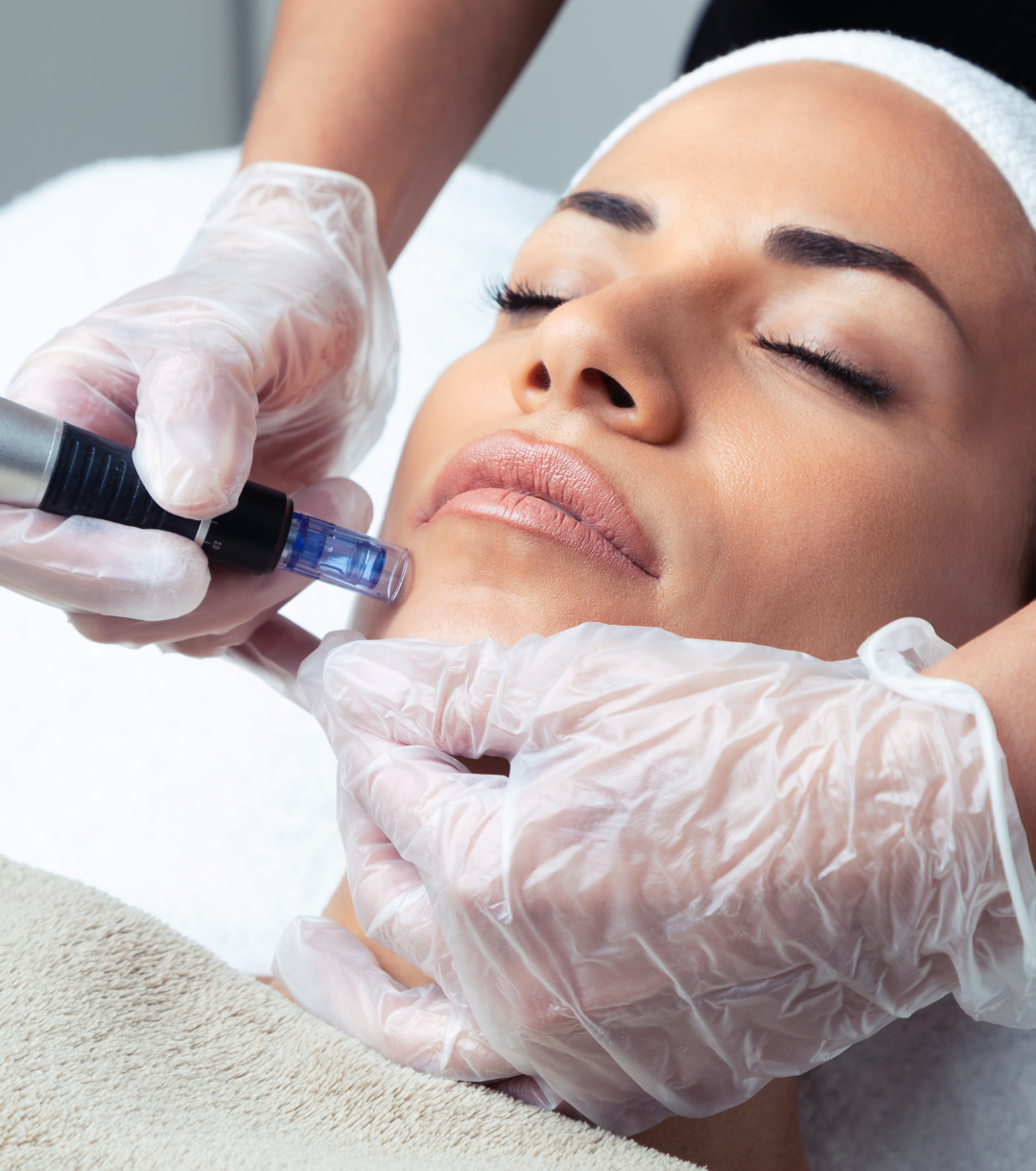 Microneedling with PRP (Liquid gold) or Hyaluronic Acid at VIVE Med Center in Miami Lakes medical aesthetics spa