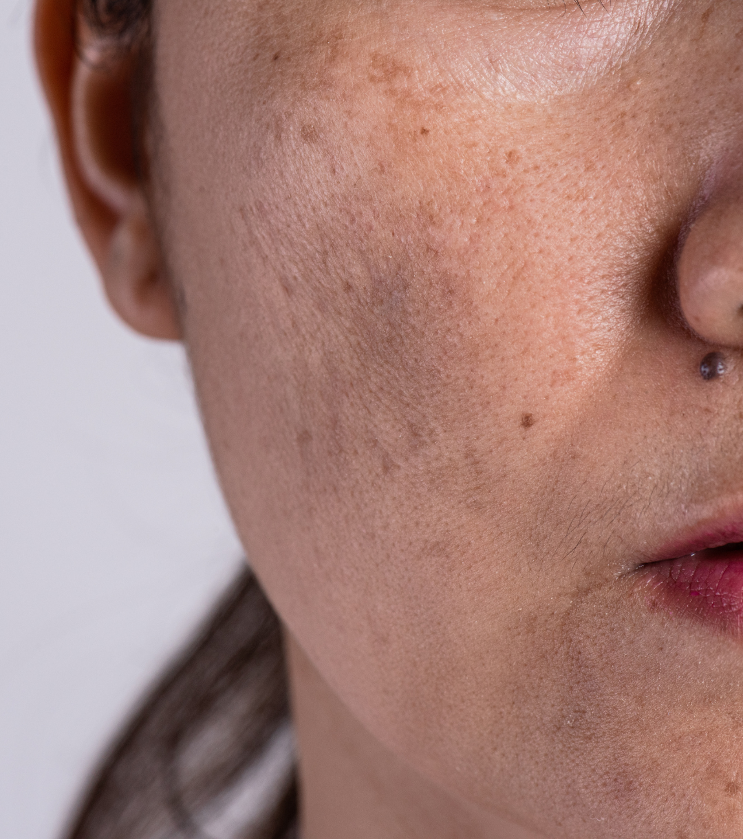 Melasma treatment at VIVE Med Center medical aesthetics and primary care